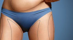 liposuction