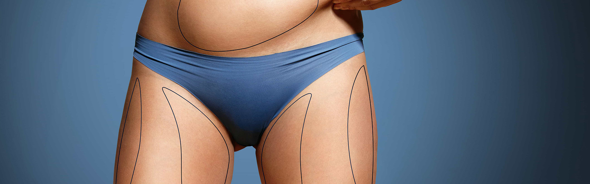 liposuction