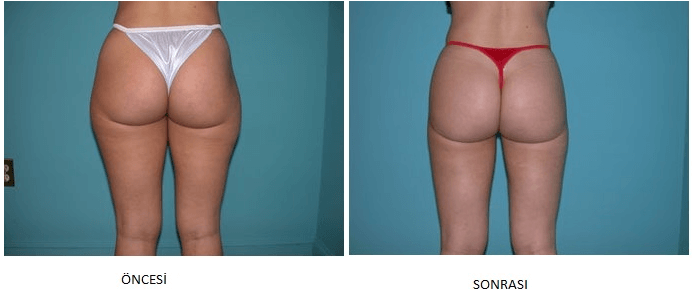 liposuction öncesi-sonrası