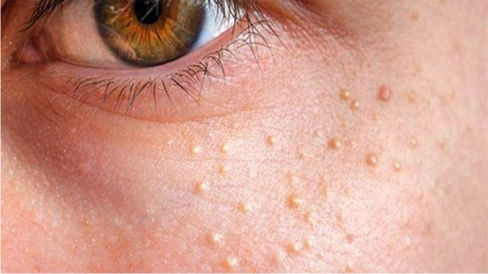 yüzdeki yağ bezesi